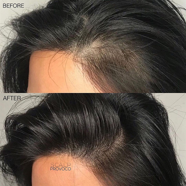 SMP women hair thinning treatment