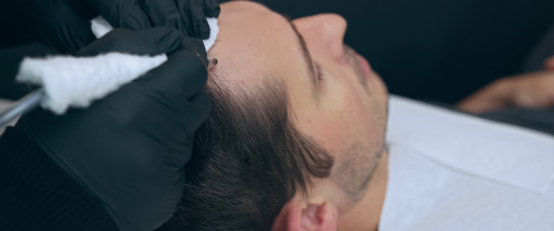 Alopecia Areata Treatment