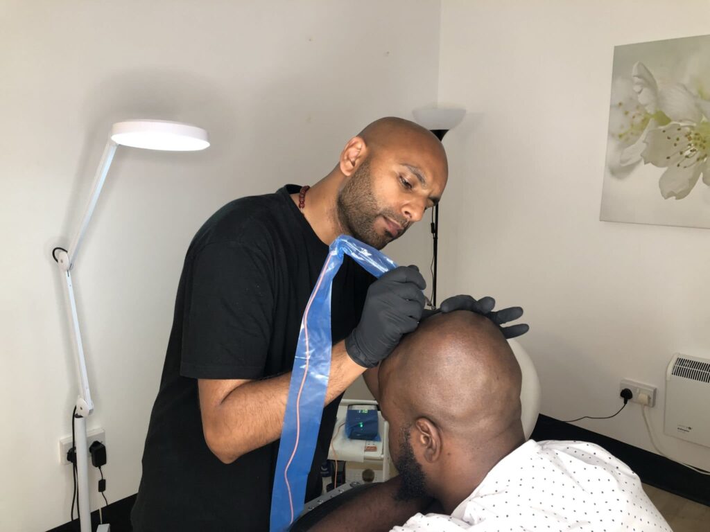 Hair Transplant Alternatives