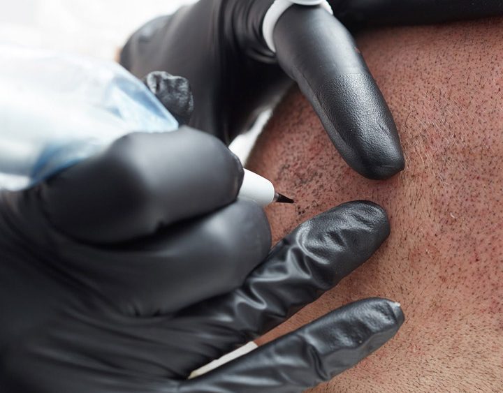 Scalp Micropigmentation