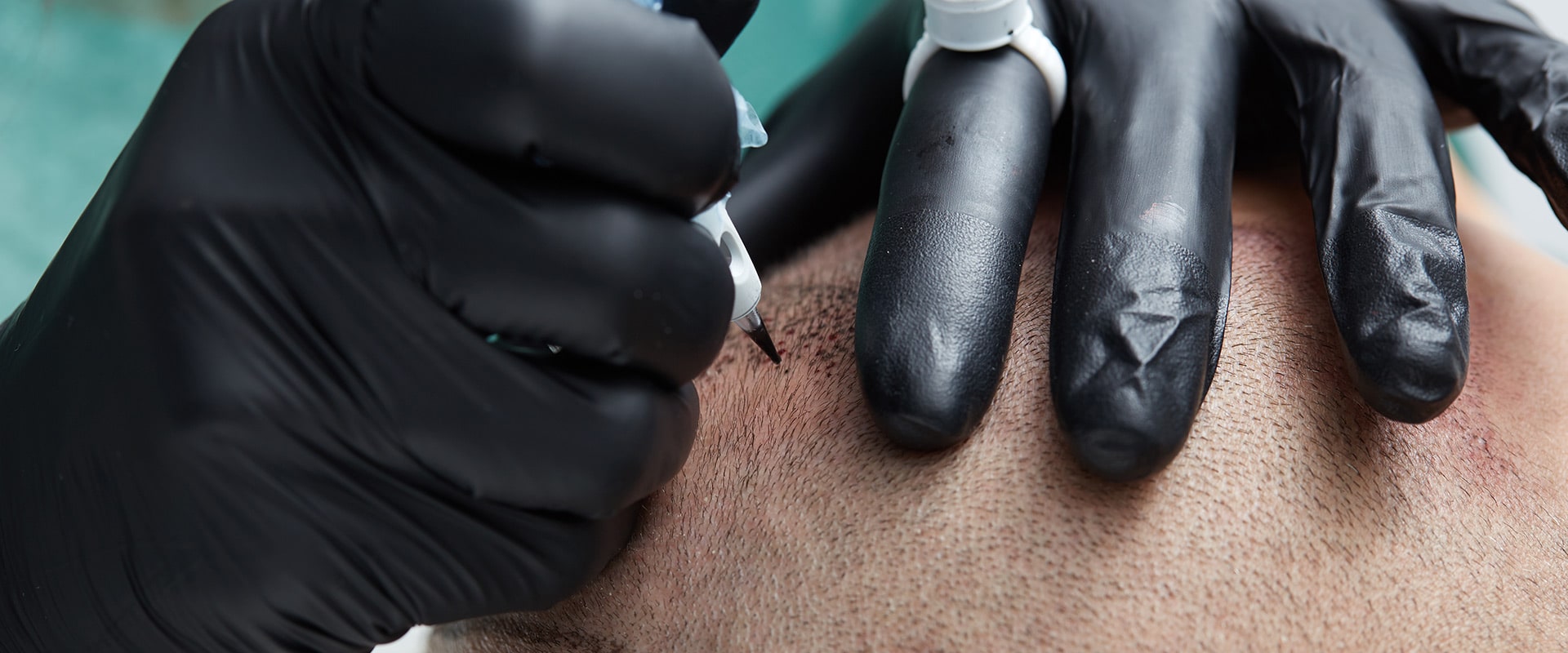 Scalp Micropigmentation Faq