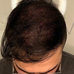 Smp Hair Density Mens After