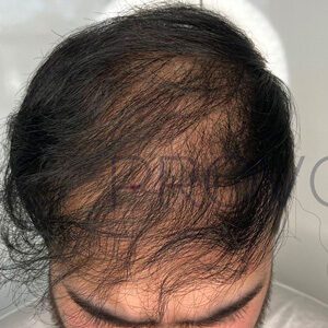 Smp Hair Density Mens Before