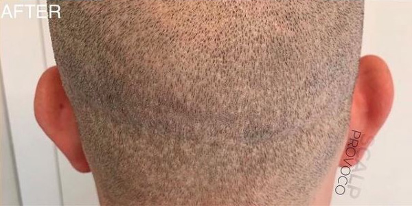 Fue Scar Coverage Scalp Provoco