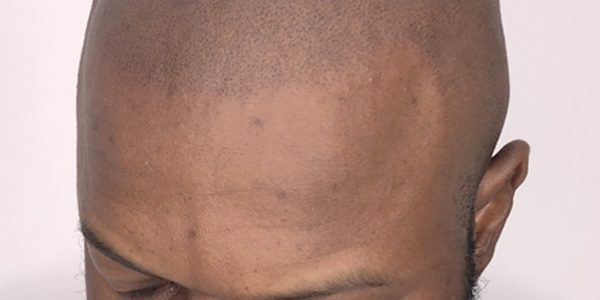 Smp Hair Line Shaven Look Scalp Provoco