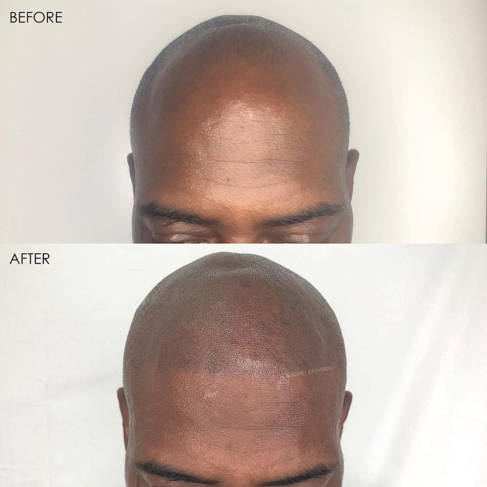 SMP Hairline brought forward bald brown skin