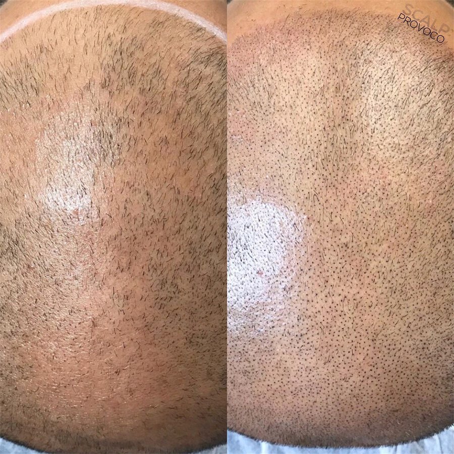 SMP Hairline top view white skin
