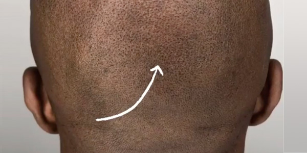 Smp Repair Correction Scalp Provoco