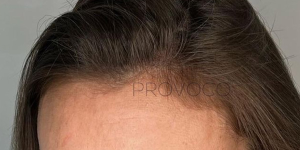 Female Smp Scalp Provoco London