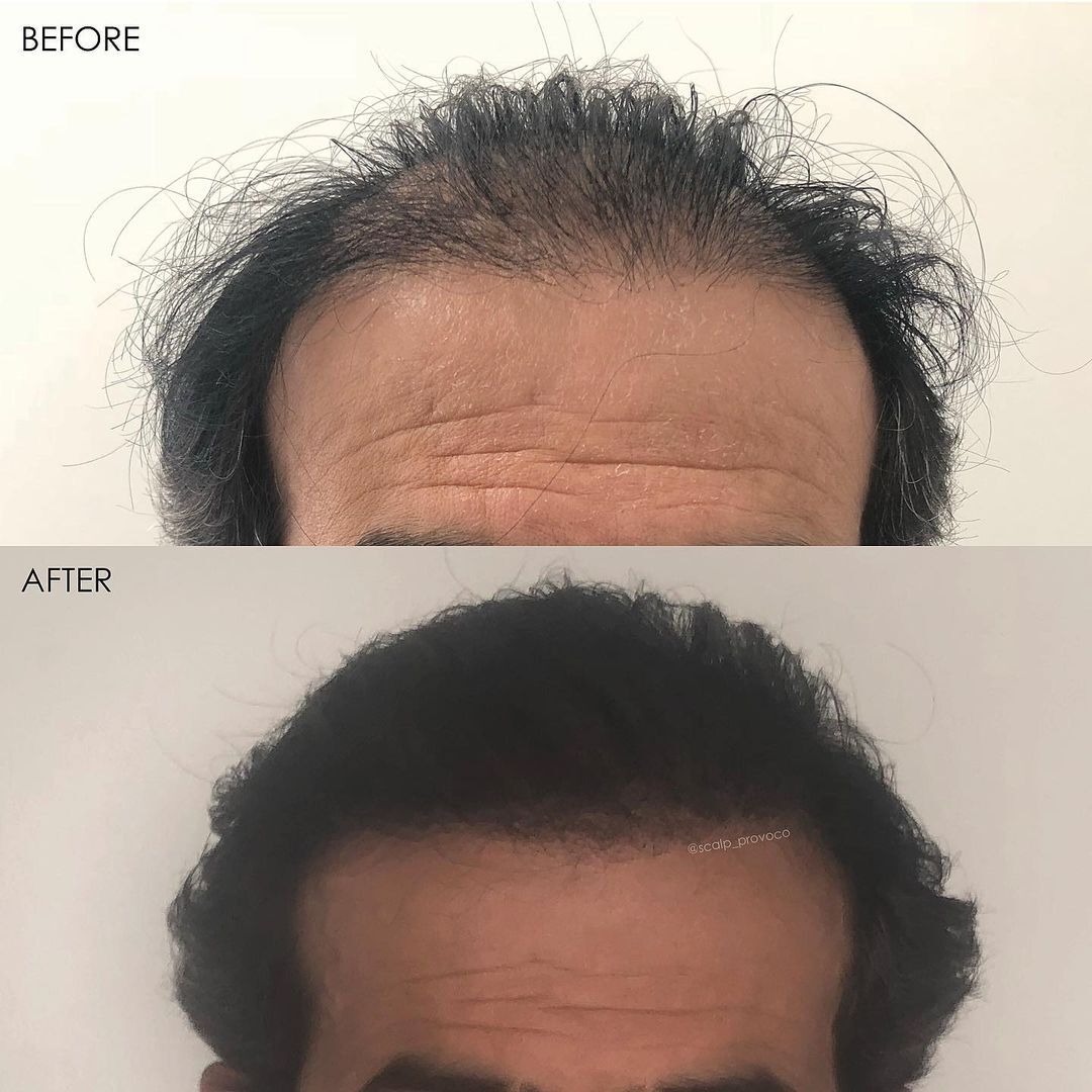 Hair Density Long Smp Provoco