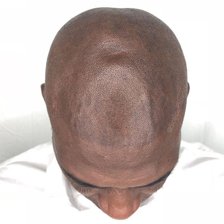 Micropigmentation By Scalp Provoco