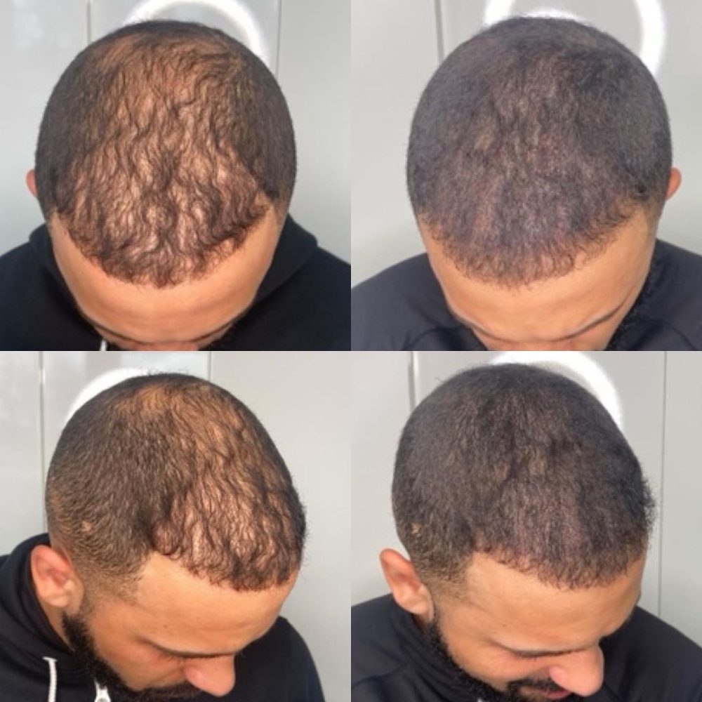Scalp migropigmentation for adding density to hair