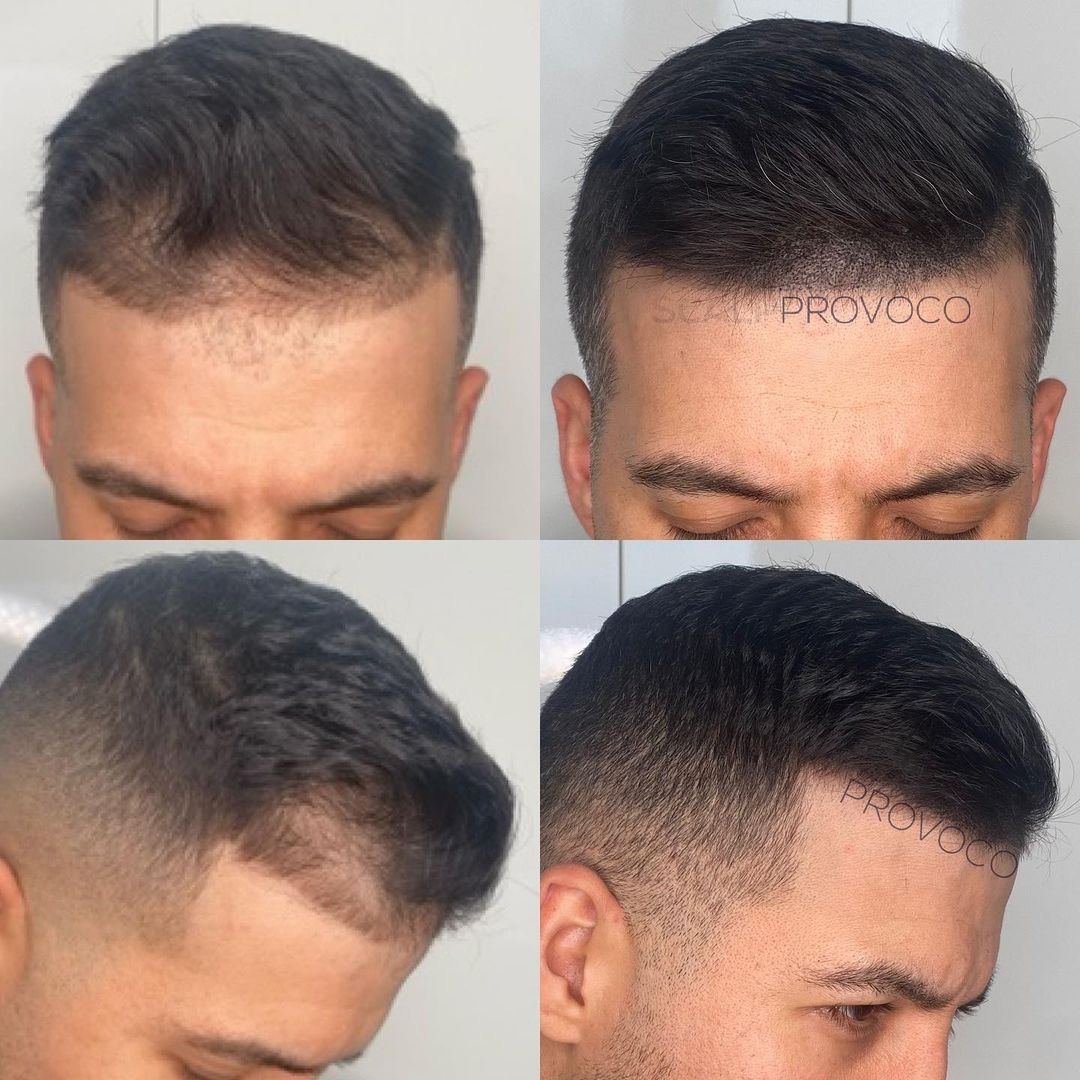 Smp Hair Treatment For Bald Or Thinning Patches