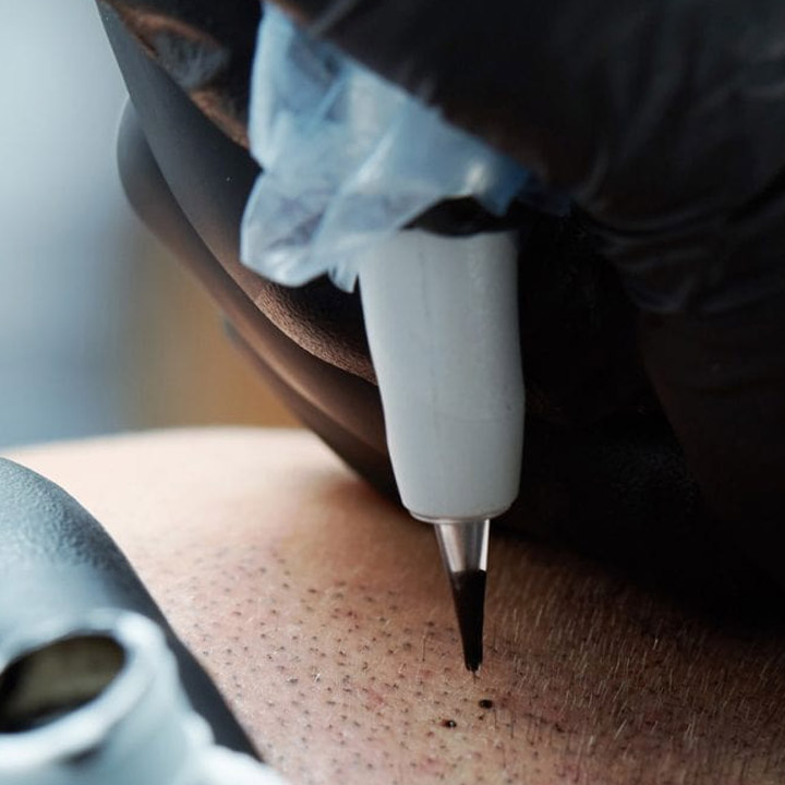 Smp Needle Device Close Up