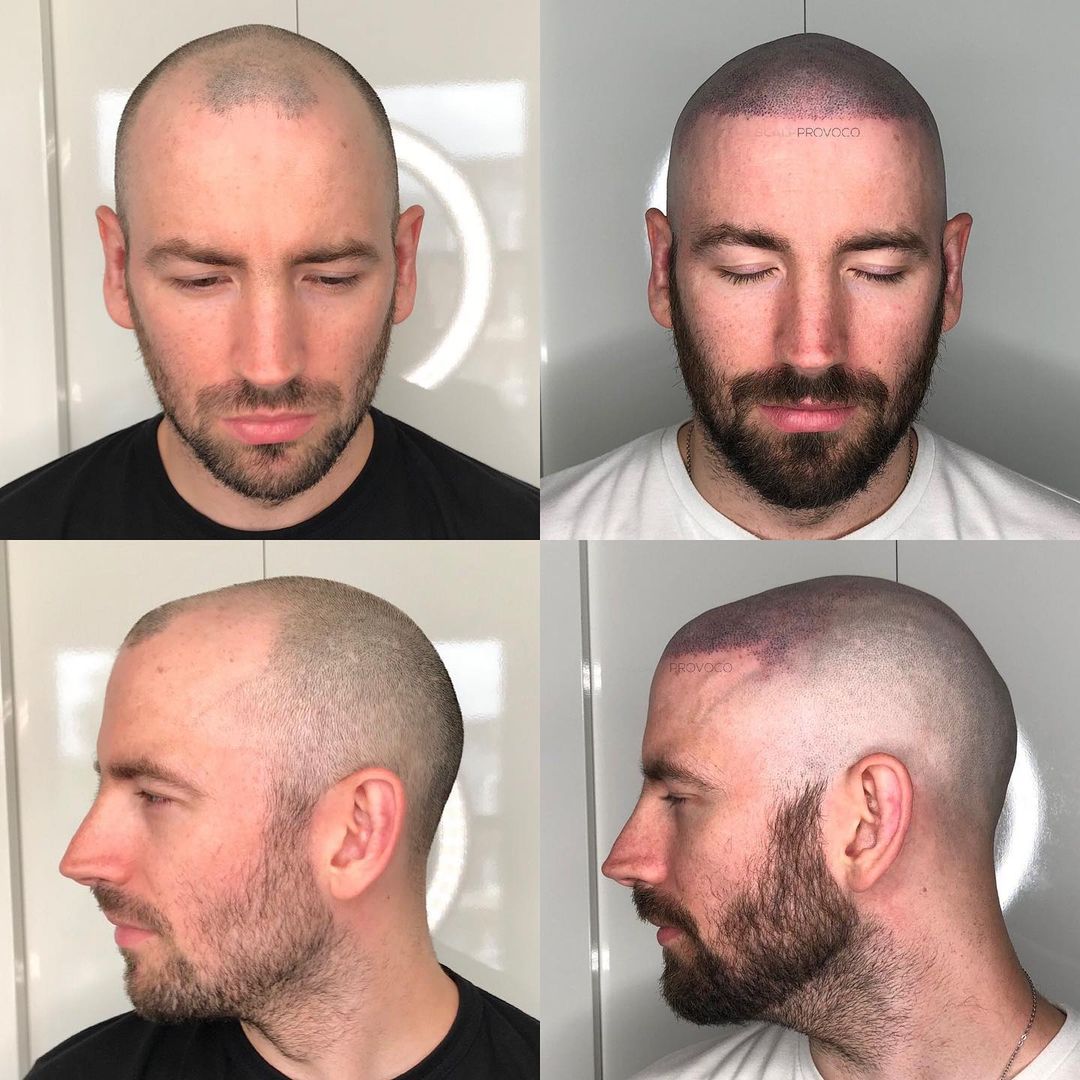 Scalp Micropigmentation