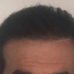 After Smp Long Hair Thinning Procedure 3b