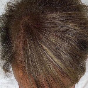 After Smp Long Hair Thinning Procedure 4b