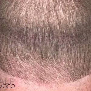 After Scar Smp Scalp Micropigmentation Provoco