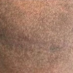 After Scar Smp Scalp Micropigmentation 3b