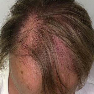 Before Smp Long Hair Thinning Procedure 4a