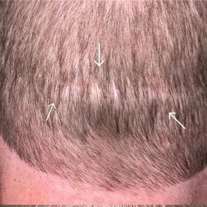 Before Scar Smp Scalp Micropigmentation Provoco