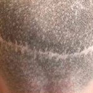 Before Scar Smp Scalp Micropigmentation 3a