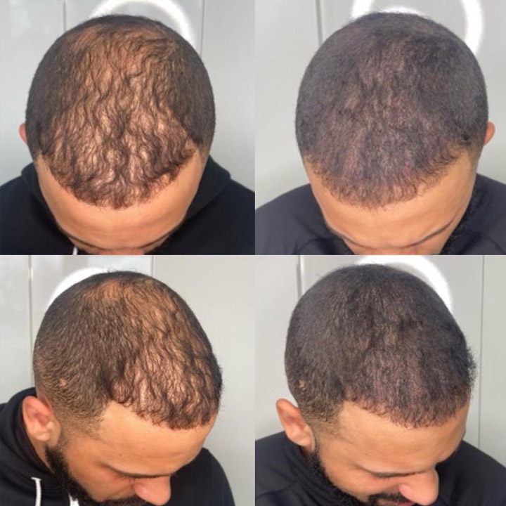 Client Hair Density SMP before after
