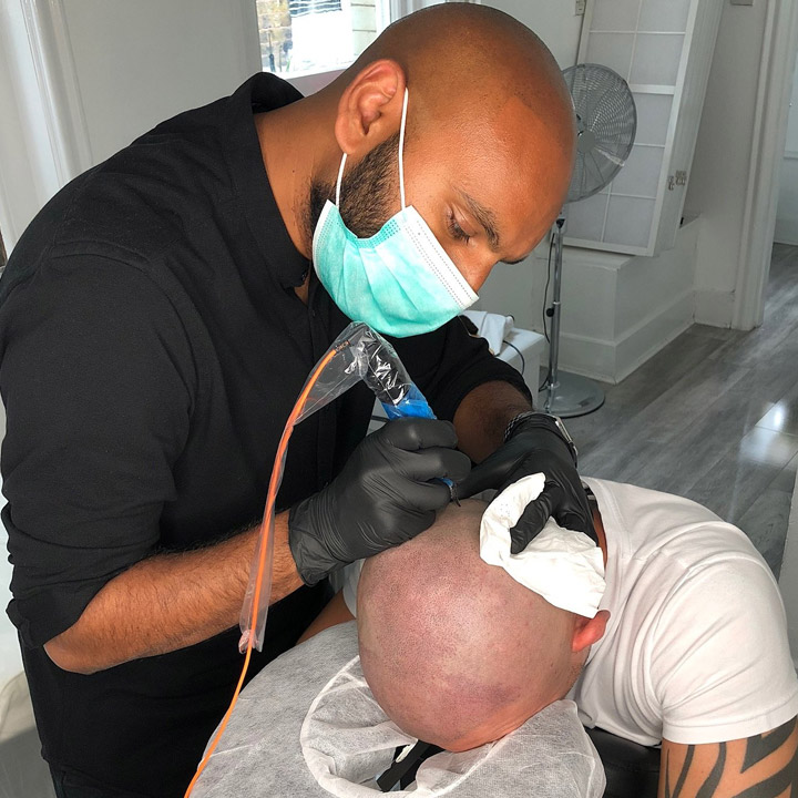 Ravi At Work Fut Transplant Scar Coverage