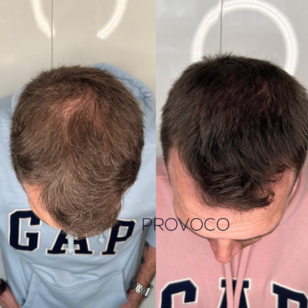 Hair density crown SMP