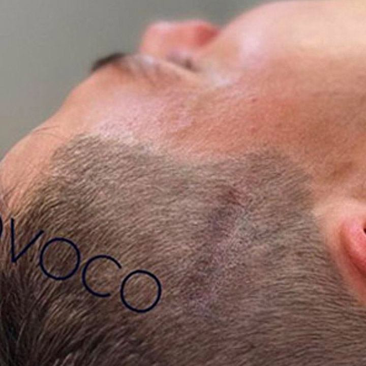 Scalp Injury Scar Smp Coverage Ravi Provoco