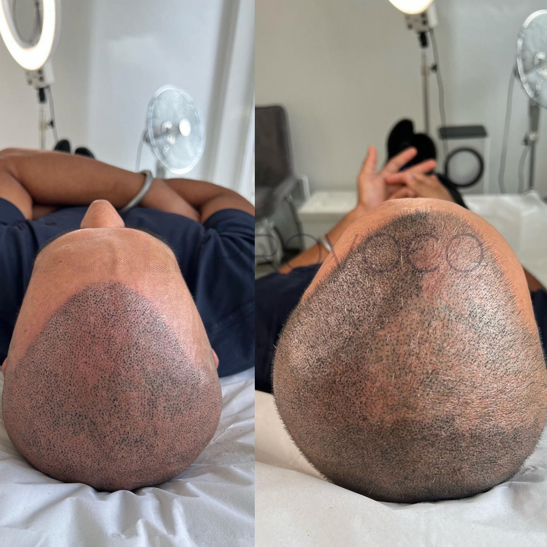 Scalp Micropigmentation Top Head Bald Cover Provoco