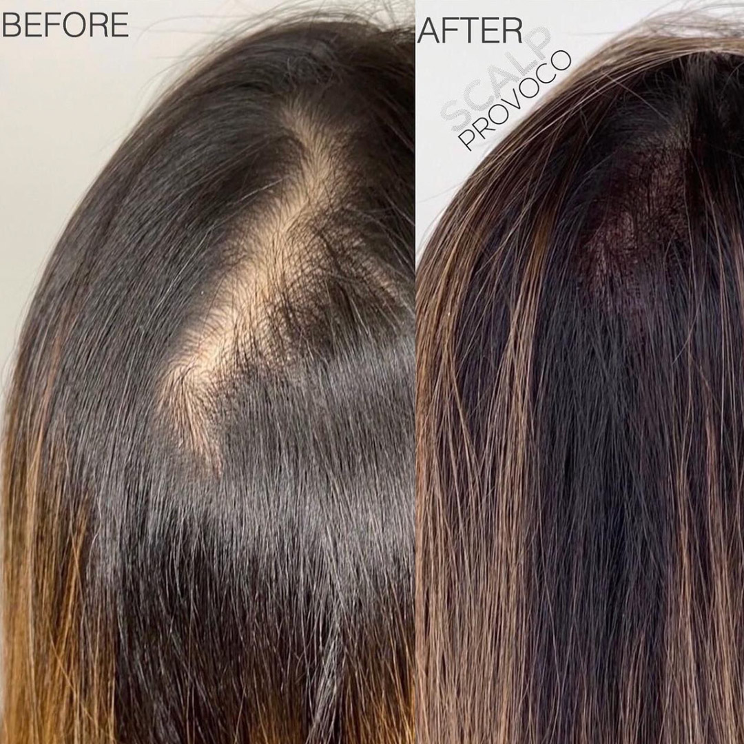Womens Smp Crown Thinning Coverage Provoco