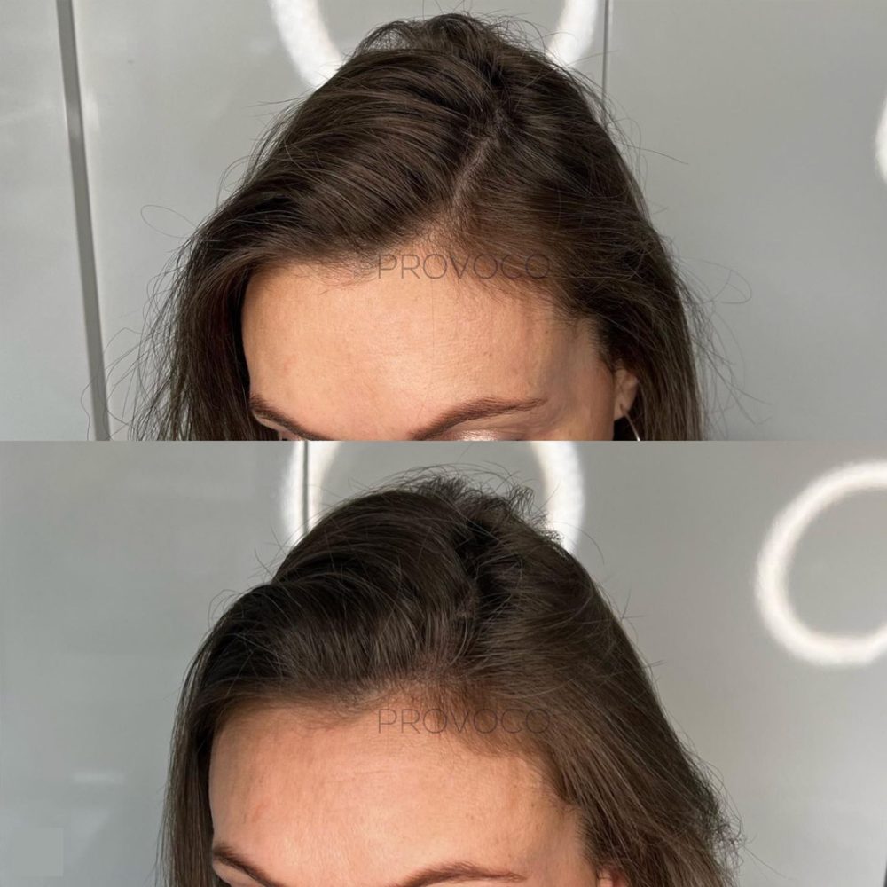 Widows peak hair pigmentation